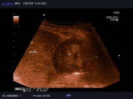 Ultrazvok trebuha - 6cm velik tumor jeter